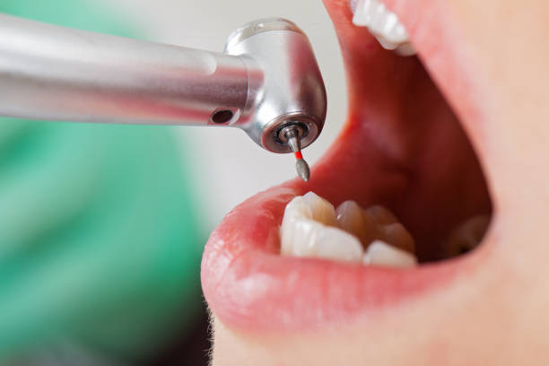 Best Emergency Tooth Extraction in Mountainair, NM